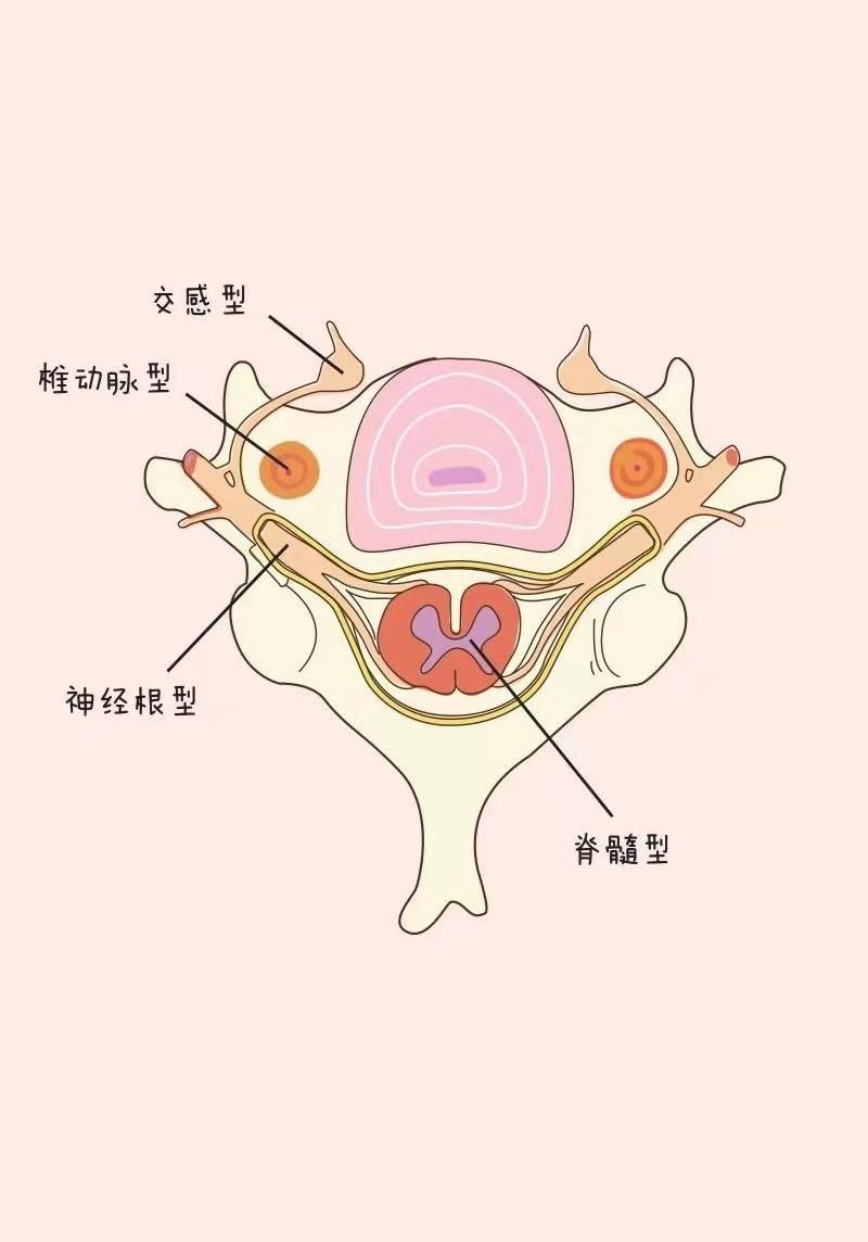 颈椎病患者纠结我这情况需要手术吗手术选择前路还是后路