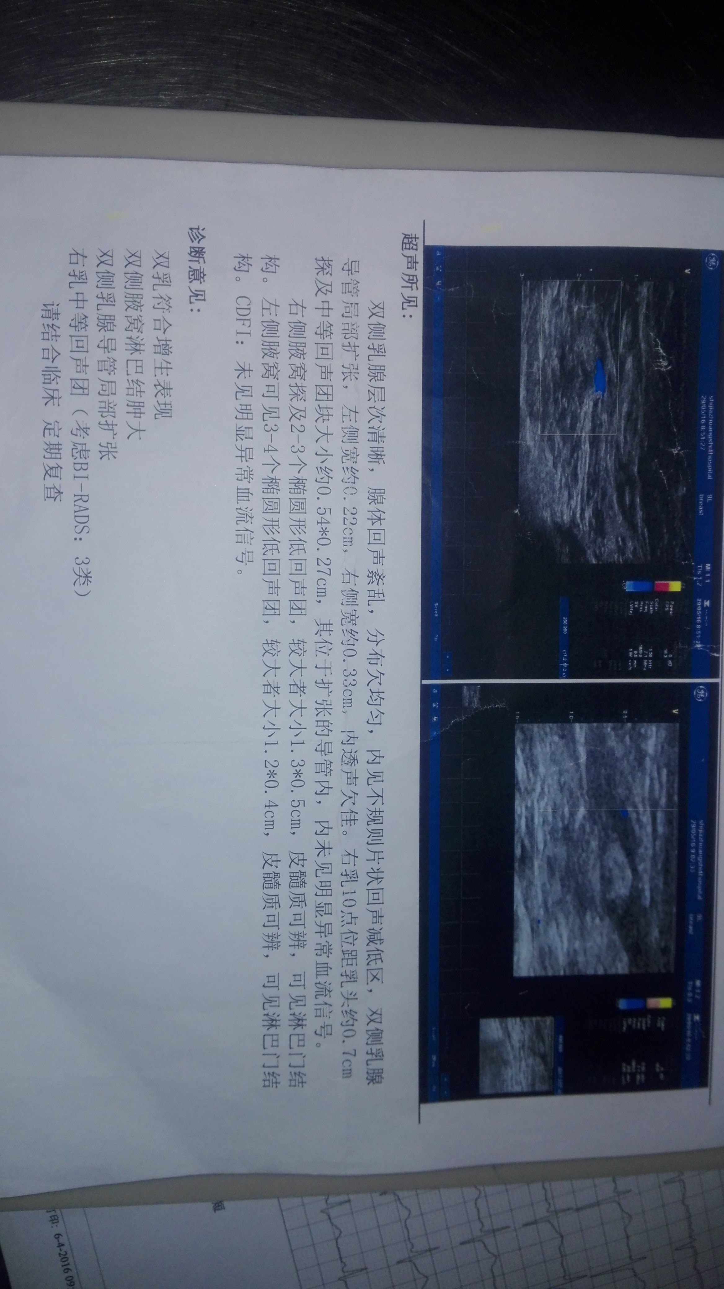 乳管内乳头状瘤