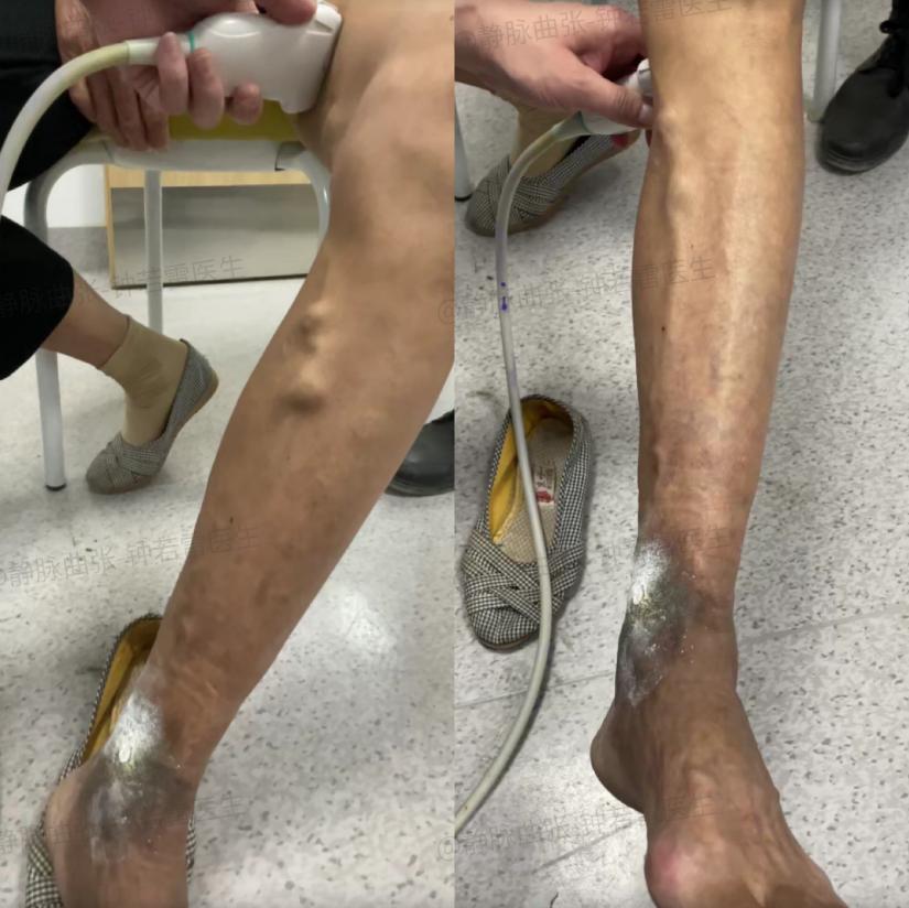 57岁阿姨腿鼓大包,脚踝溃烂,「逃离」城郊三个针孔破局