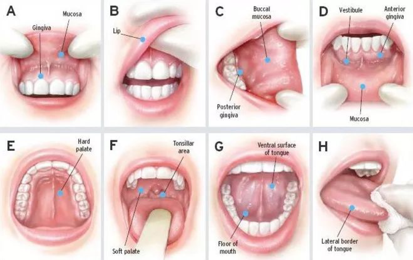 口腔癌分期解读：口腔癌分期具体是怎么分的？_健康号-微医