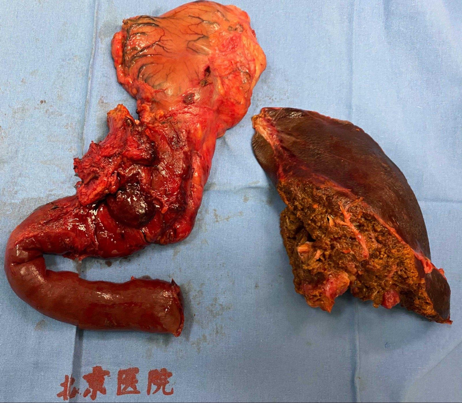 老年患者诊断胆总管癌合并肝内胆管癌是否能一次手术解决