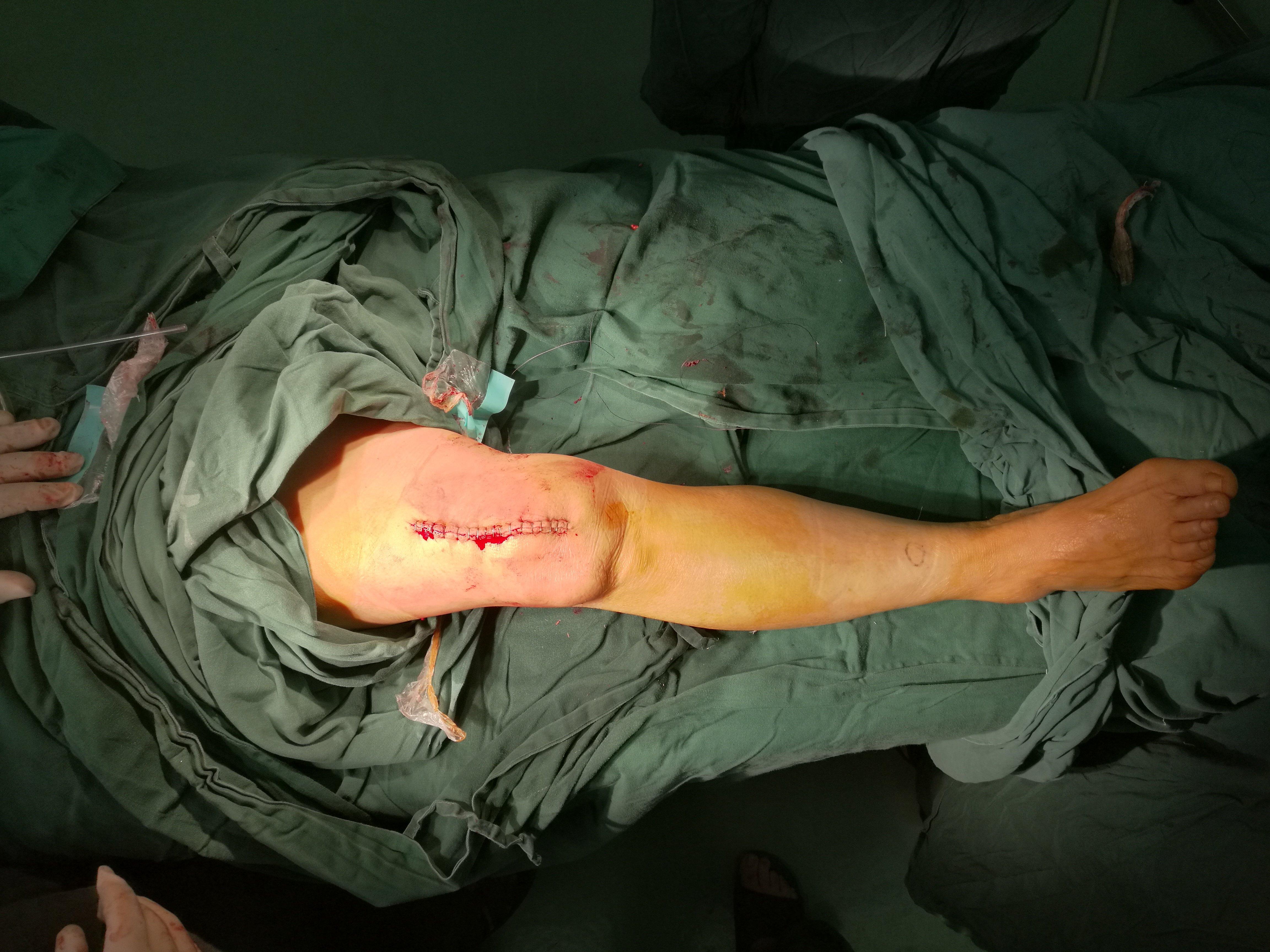 外翻膝关节外畸形股骨远端闭合截骨术