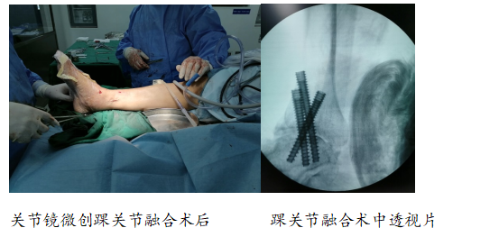 30多年的旧伤关节镜下踝关节融合术一招搞定