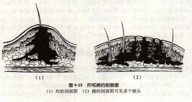 毛囊炎疖子痈皮脂腺囊肿这样分的清