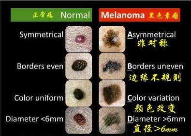 黑痣的常见问题.是否会恶变?是否需切除?术后有疤吗?