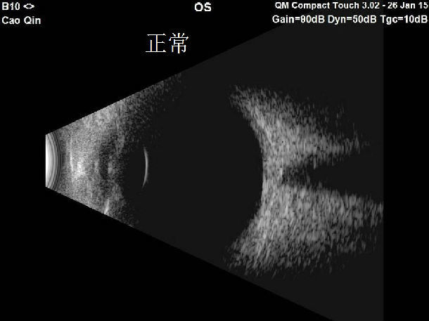 孔源性视网膜脱离_李继鹏医生文章_首都医科大学附属北京同仁医院