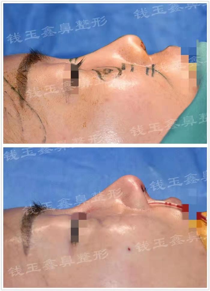 全自体肋软骨鼻综合