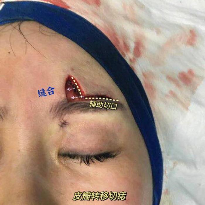 术中由于痣面积较大,所以利用眉上切口推进部分皮肤至缺损部位愈后