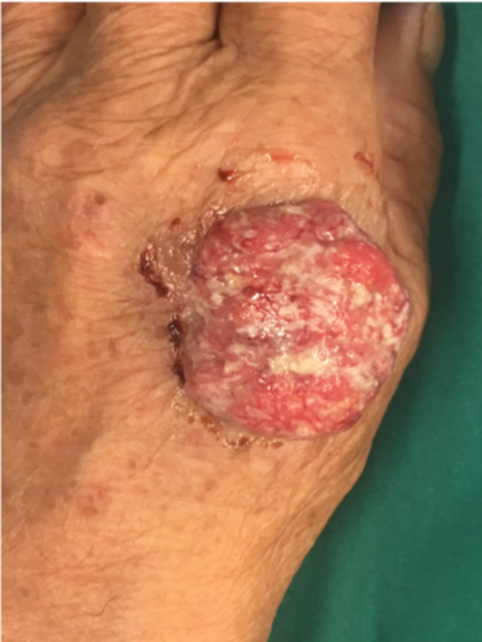 手部皮肤肿物_杜子婧医生文章_上海交通大学医学院附属第九人民医院