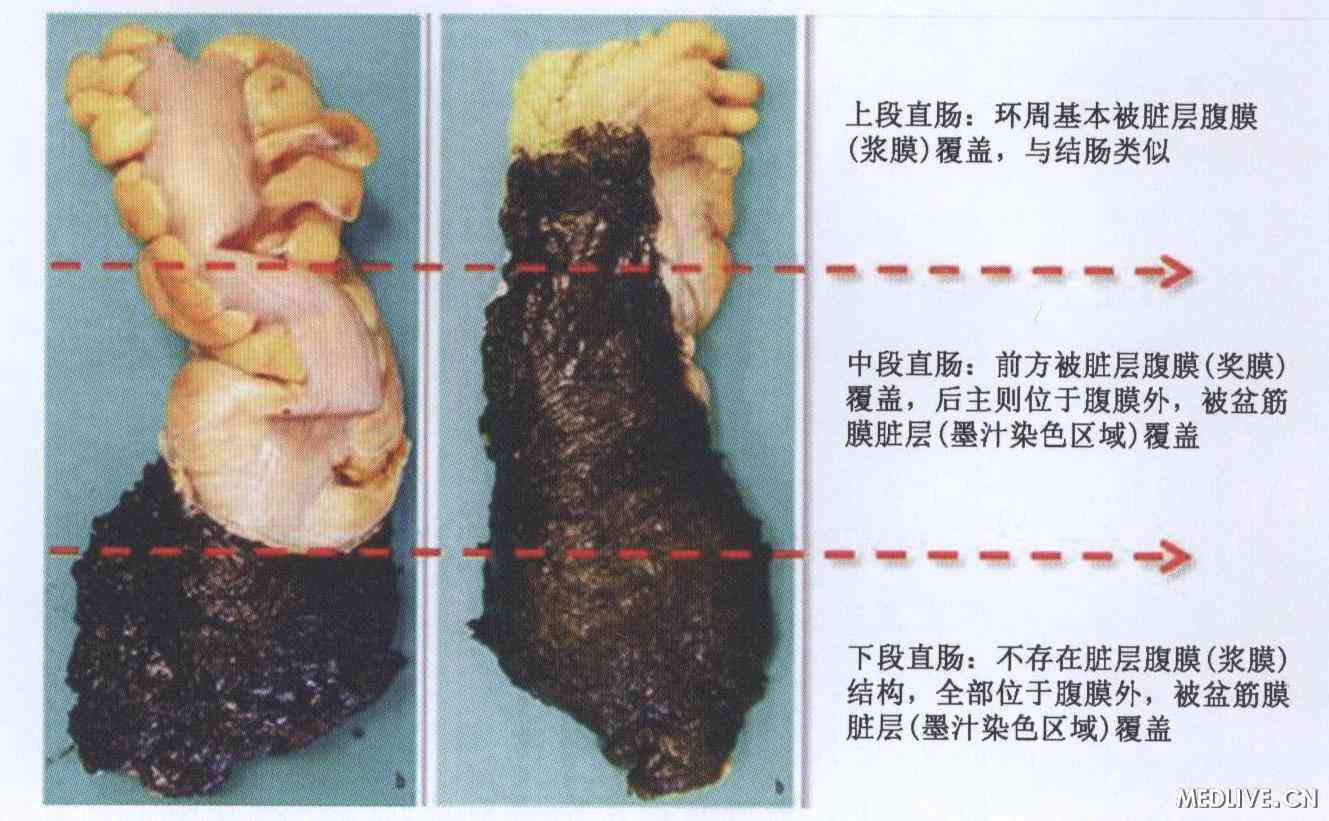 图1 在高质量全直肠系膜切除术后标本上,可较容易辨认出直肠上中下段