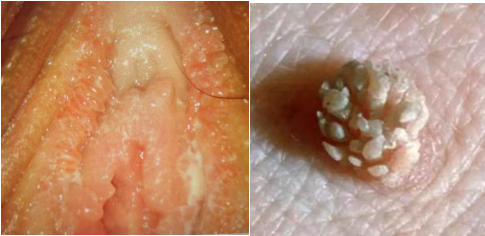 假性湿疣本身并不影响身体健康,无需特殊治疗,也无传染性,若合并阴道