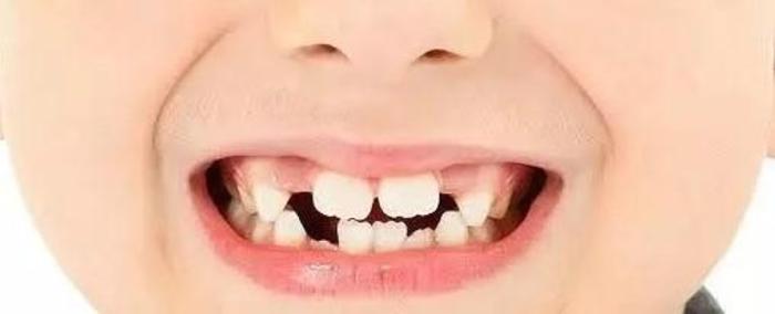 娃新换的门牙中间有缝到底要不要治疗