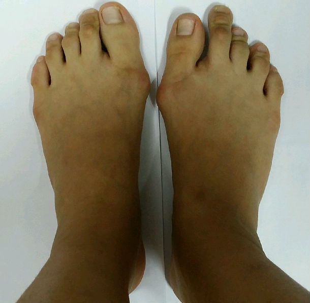 女性脚趾长不美观怎么办