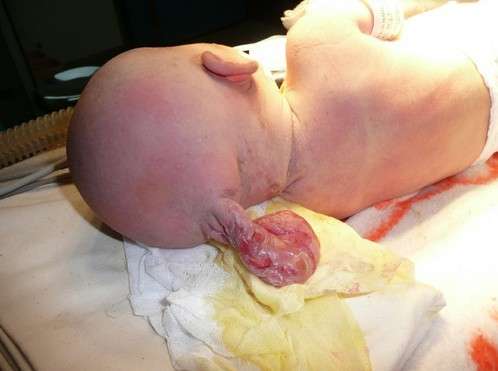 婴儿头上的尾巴先天性脑膜膨出的治疗