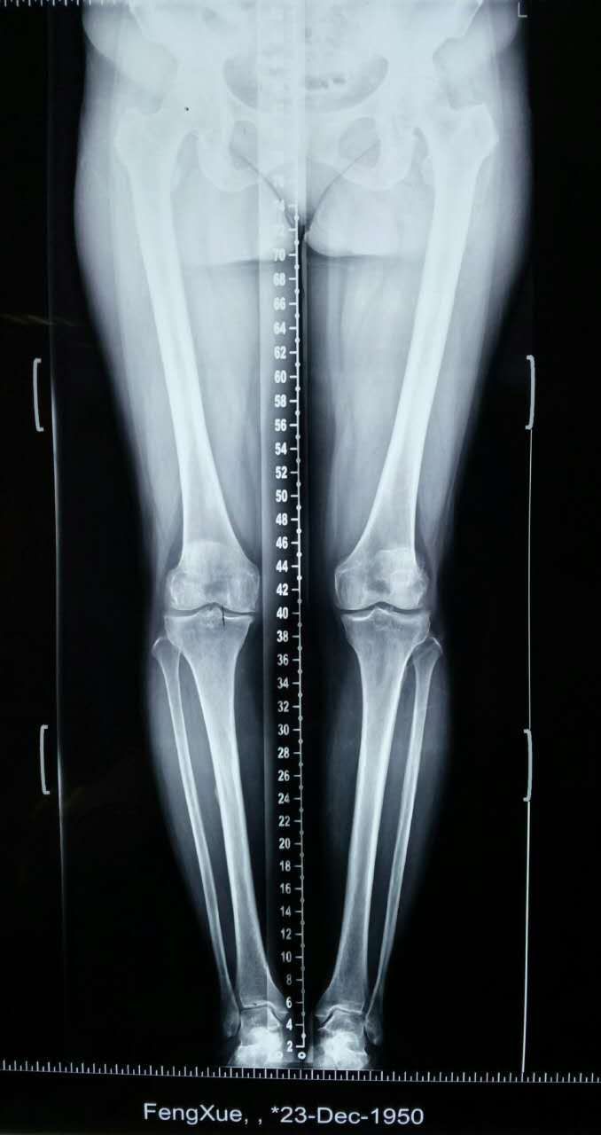 67岁女性,膝关节骨性关节炎,微创单髁关节置换.