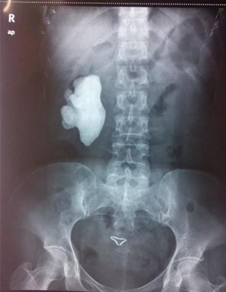 右肾铸型结石术后kub平片(西门子泌尿x线诊疗系统):肾结石无残留ems清