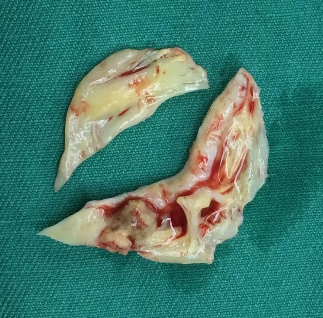 心脏瓣膜病患者必看