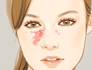 鲜红斑痣红胎记的激光治疗