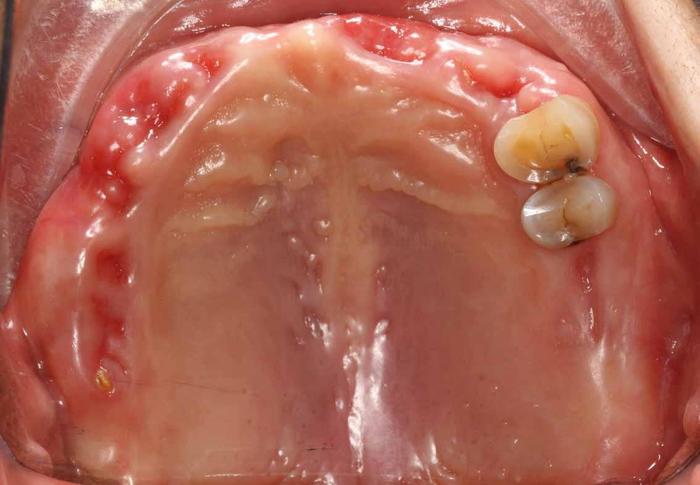 缺牙最后的挣扎全口缺失种植牙修复