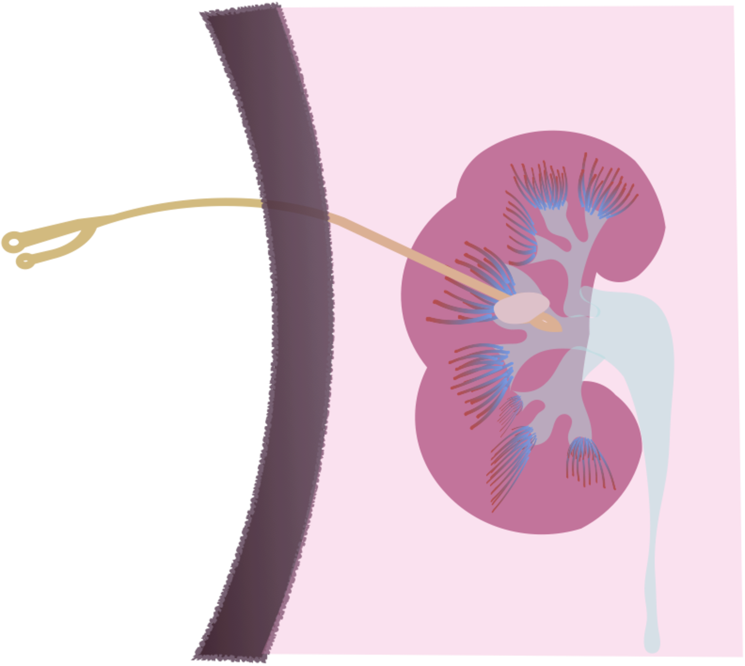 什么是肾造瘘,为什么要做肾造瘘?_健康号-微医