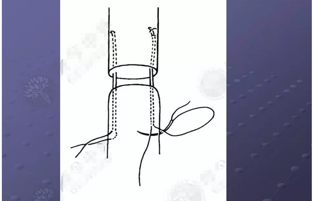 汤氏肌腱缝合法图片