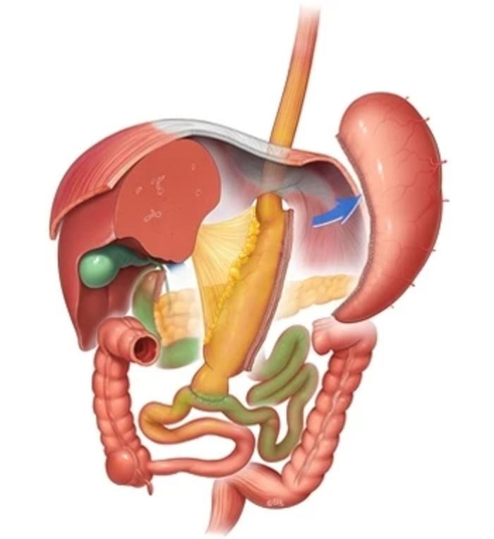 胆胰转流十二指肠转位术(biliopancreatic diversion with duodenal