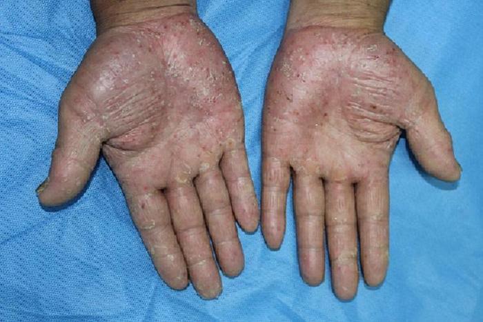 金纽尔在掌跖脓疱病中的应用