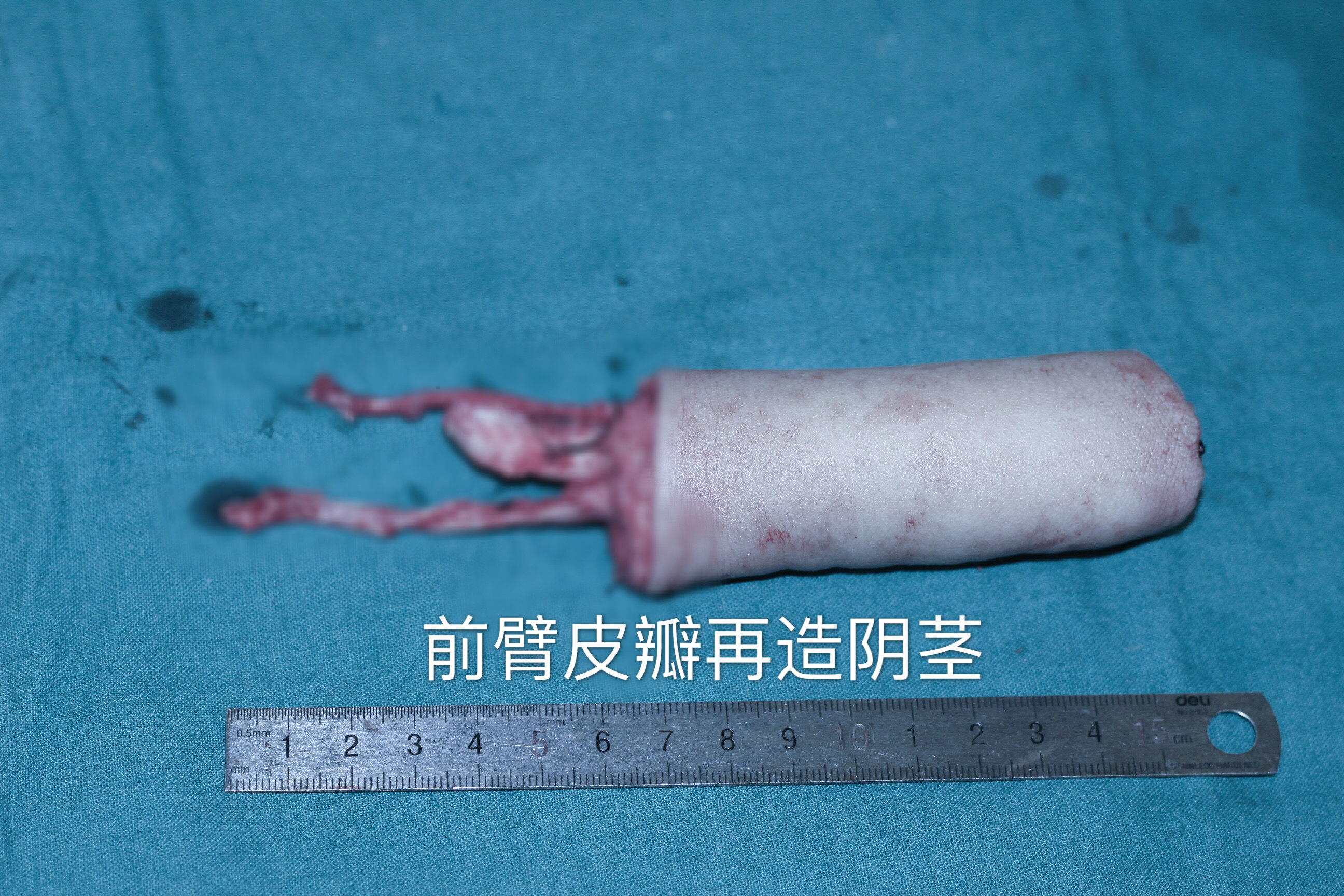 双皮瓣阴茎再造外形更美供区更好