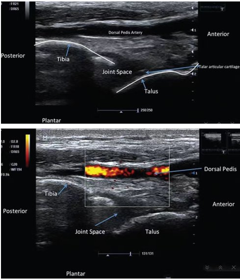 神经和血管踝关节前面长轴短轴图像中点位于姆长伸肌和胫骨前肌之间30