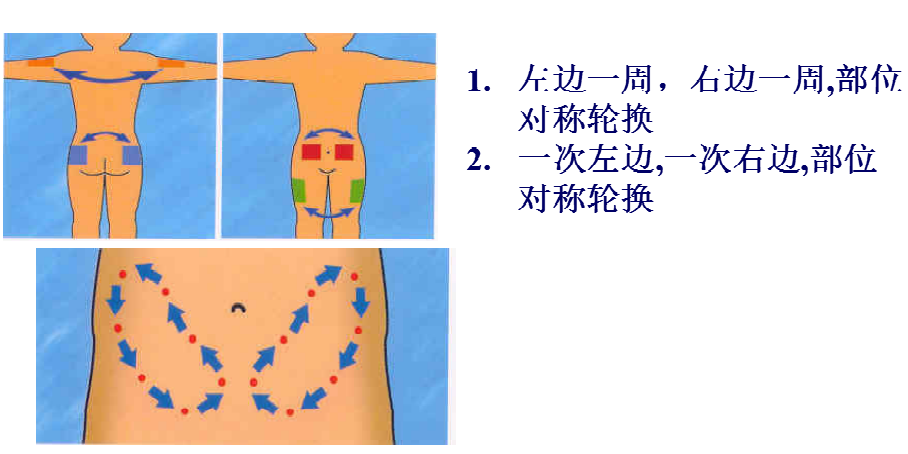 胰岛素注射部位图解