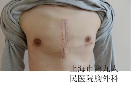 严重鸡胸手术治疗不复发