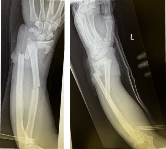 前臂损伤尺桡骨骨折