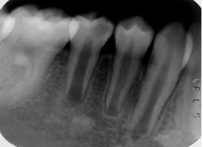 完全形成和成熟;其主要特点是牙根短,根管粗大,根尖孔呈喇叭口状(图1)