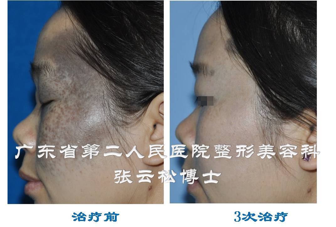 太田痣系列科普一患了太田痣我要恭喜您附对比图片