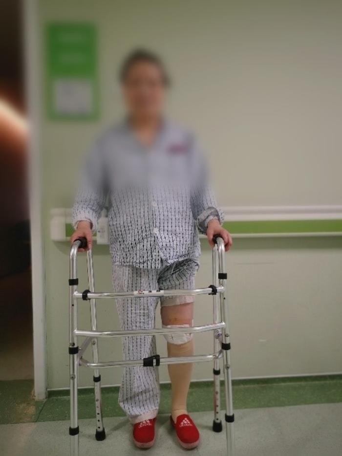 单髁小切口出院指导:患者早期的康复锻炼在医院完成,建议2周内助行器