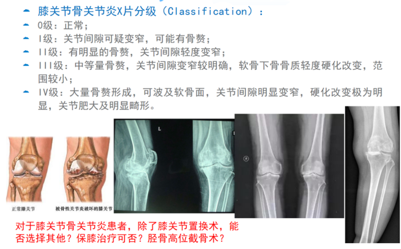 胫骨高位截骨术保膝治疗膝关节骨关节炎 健康号 微医