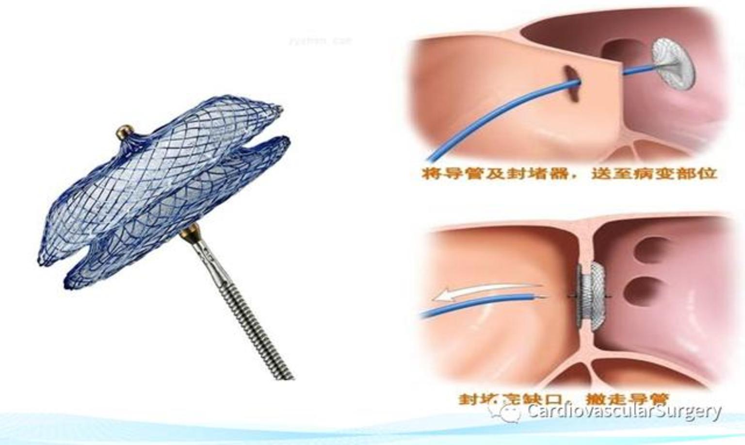 房间隔缺损封堵,室间隔缺损封堵,动脉导管未闭封堵等;介入微创心脏