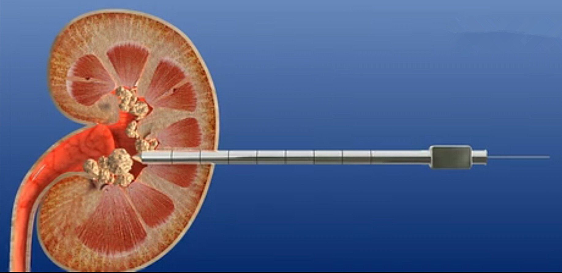 经皮肾镜肾脏结石治疗的大杀器