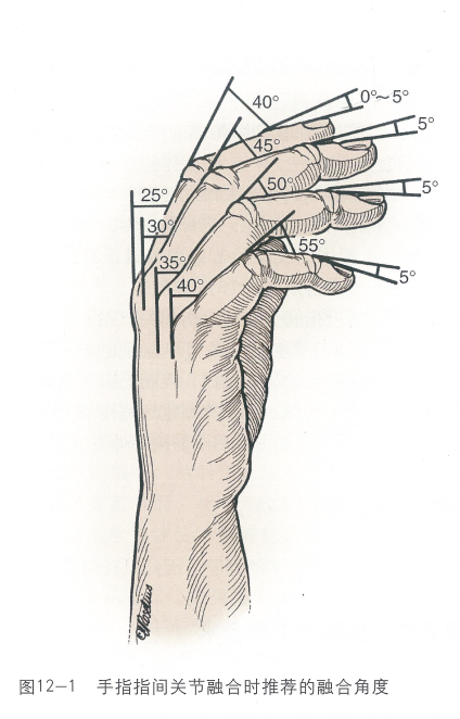 手部关节的融合角度选择