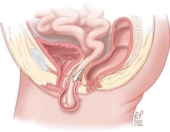 子宫脱垂患者招募