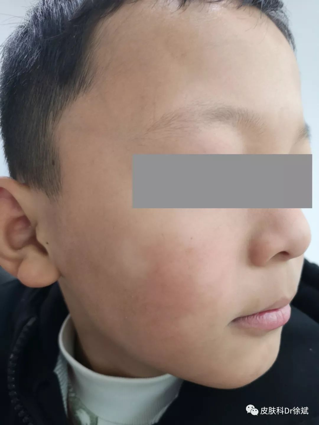 儿童面部白斑怎么办?别慌,可能和白癜风没有半毛钱关系!