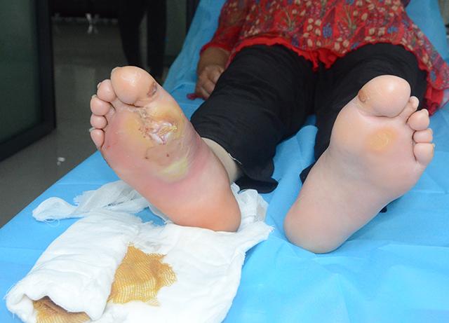 糖尿病患者因老茧处置不当导致严重的糖尿病足患者