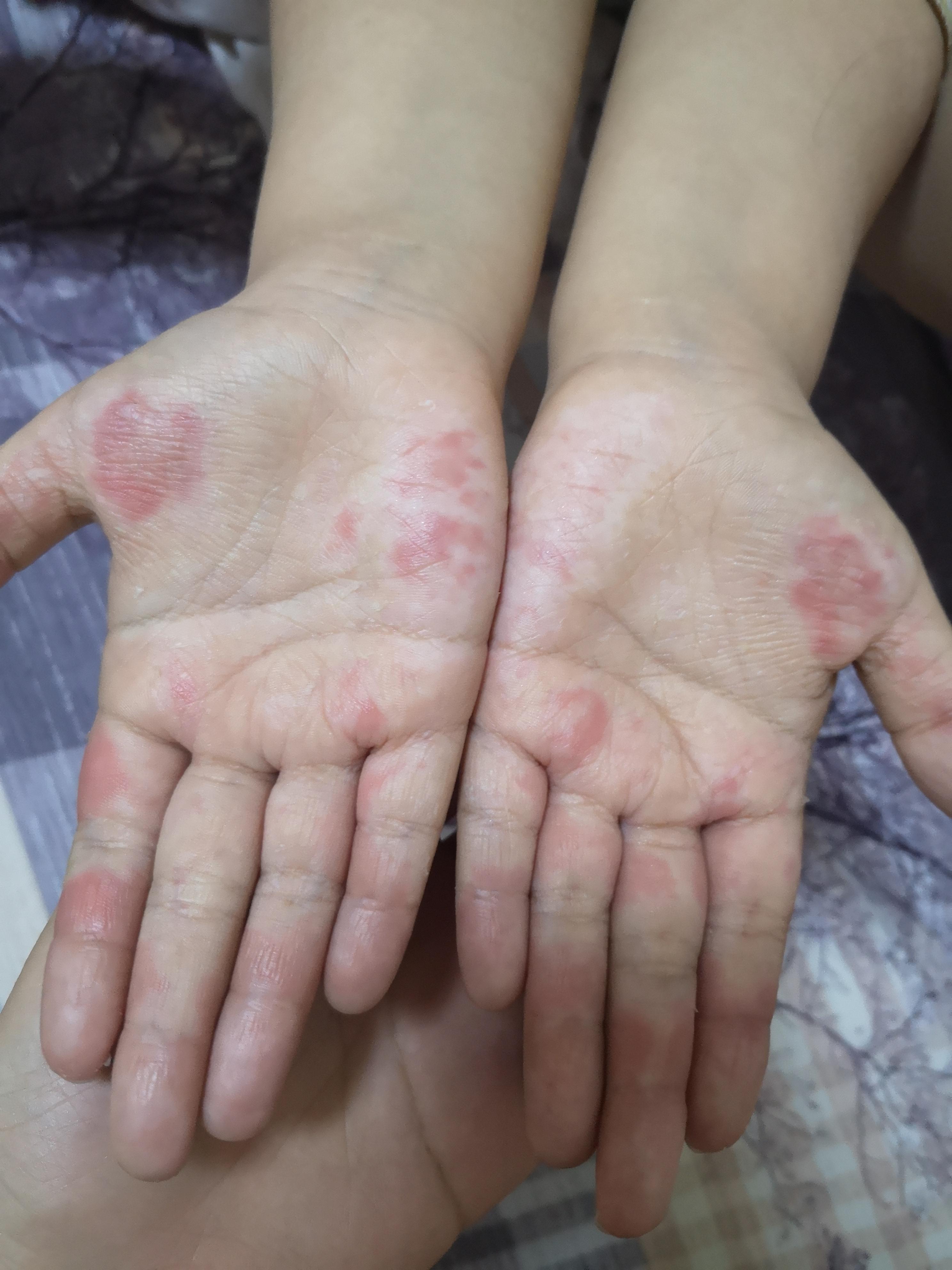 7岁儿童,之前秋冬季手掌也脱皮,但是没这次严重,快一个月了,脱皮越来