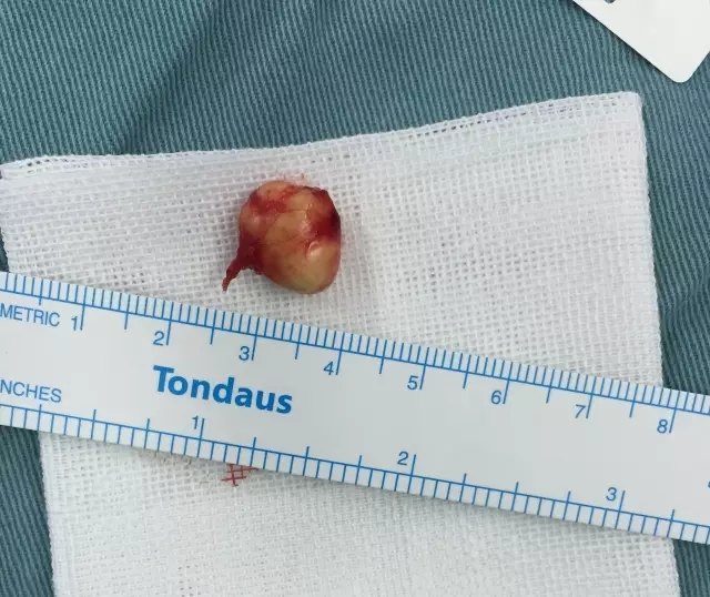 儿童常见的眼眶肿物表皮样囊肿