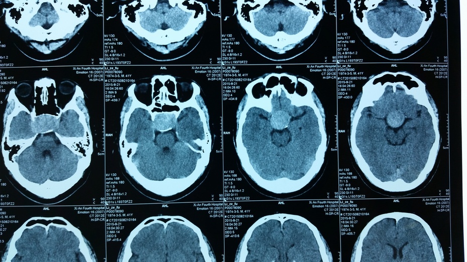 ct:鞍内占位,等高密度,骨性蝶鞍区扩大,鞍底破坏.