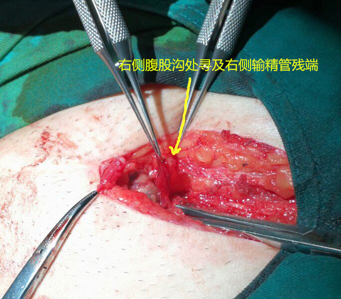 輸精管搭橋 交叉吻合術治療疝氣術後梗阻性無精症