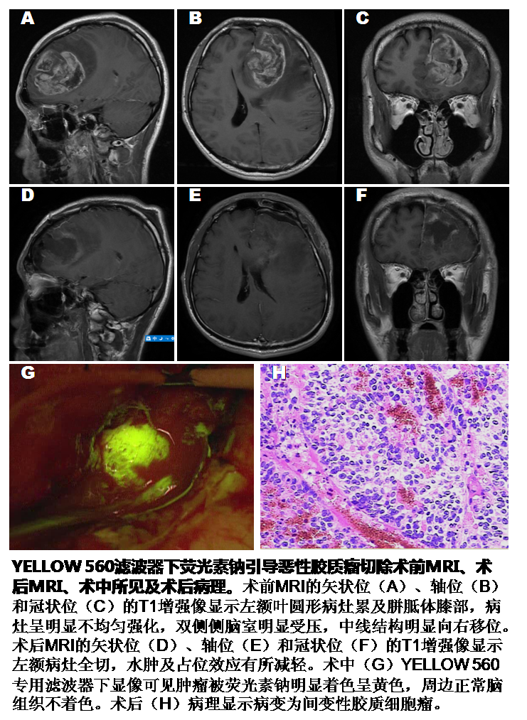 脑胶质瘤是最常见的成人原发性恶性脑肿瘤,尤以恶性胶质瘤常见.