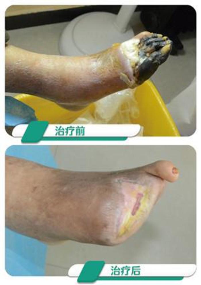 糖尿病足烂脚必须要截肢吗