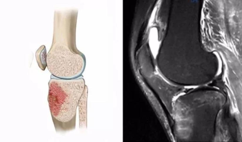 膝关节外伤 对膝关节损伤诊断极为重要的外伤性骨髓水肿 健康号 微医
