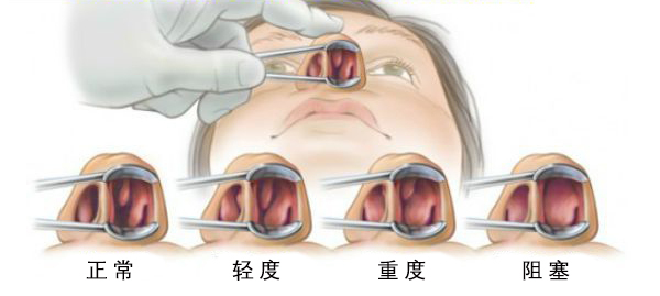 鼻中隔手术图解图片